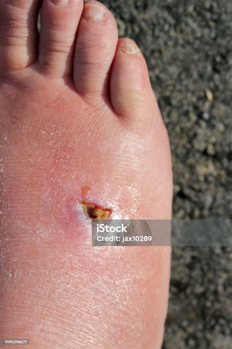 Cicatriz De Ferroada De Arraia - Foto de Necrose Tecidual Causada Por Lesão Por Chicote De Arraia Quatro ...