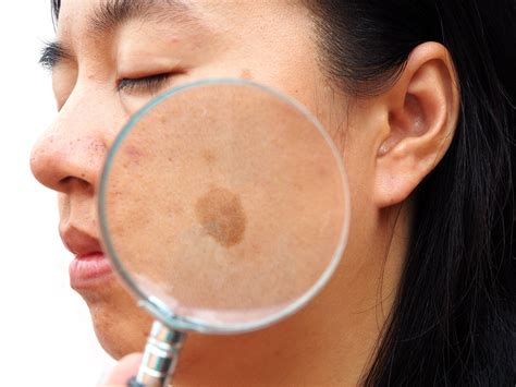 Melasma treatment possibilities expand thanks to new research