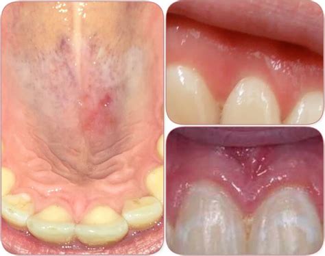 White Spot on Gums and Mouth with no Pain, What to Do?