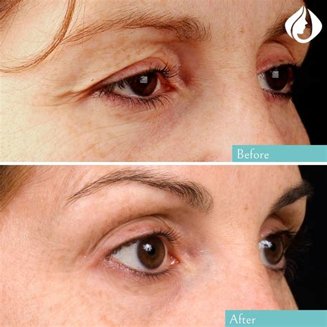 thermage toronto north york markham la vitalite med spa