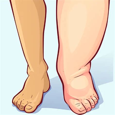 lymphatic filariasis elephantiasis package test price  delhi india