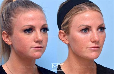 Souirensu It Works: My Before & After Photos Will SHOCK You! - tcpatah