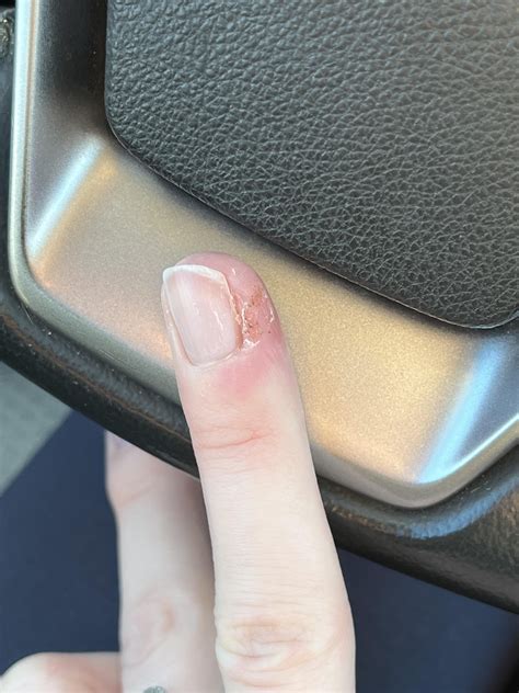 Making progress. Compound W salicylic acid bandaid, debriding and I