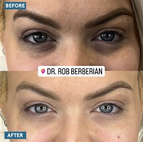 Under Eye Filler Newport Beach | Orange County | Dark Circles ...