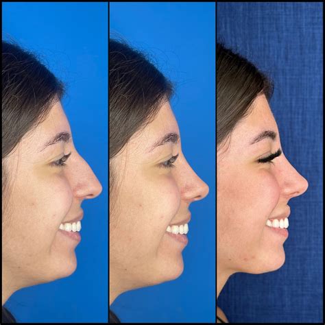 Quanto Tempo Depois Da Rinoplastia Posso Assoar O Nariz - Doutor: como vai ficar meu nariz depois da rinoplastia?