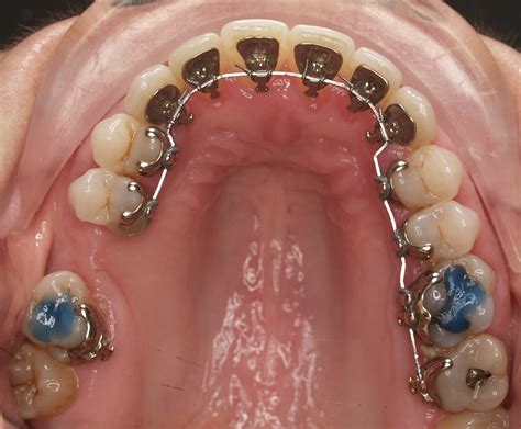 lingual braces  teeth braces kingston orthodontics
