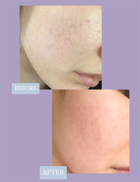 Before and After results of Tatcha's Vit... - Beauty Insider Community