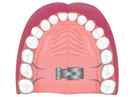 palate expander exercises  darren pennington blog