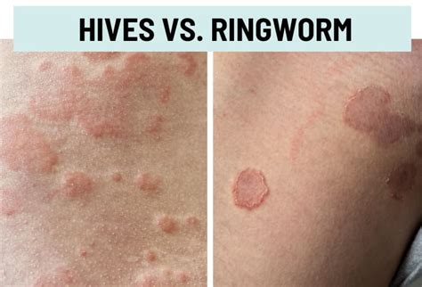 Hives (Urticaria) vs. Rash: Pictures and Differences
