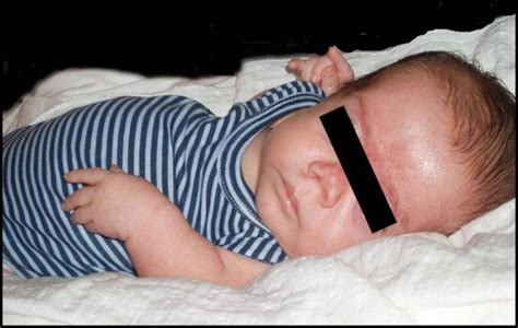 patient   years note flat mid face depressed nasal bridge