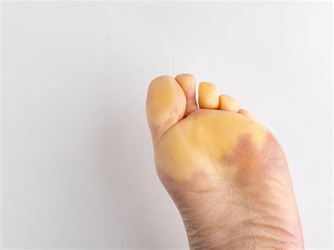 Raynaud’s Disease | The Chelsea Clinic Chiropodists Podiatrists