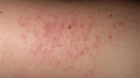 What Causes Small Red Itchy Bumps On Skin