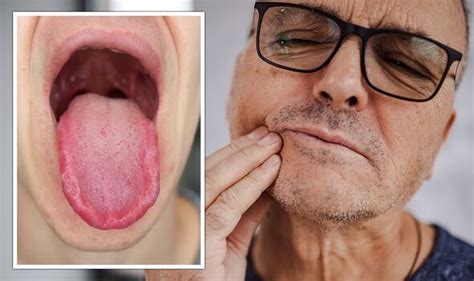 'Burning mouth' syndrome could reveal several underlying health ...