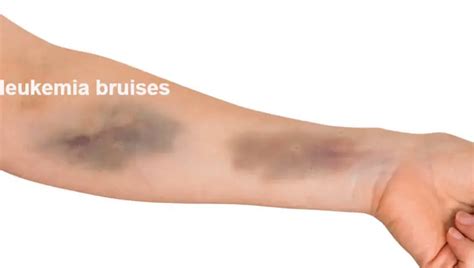 Are Bruises A Sign Of Leukemia? What do leukemia bruises look like? - Body Pain Tips