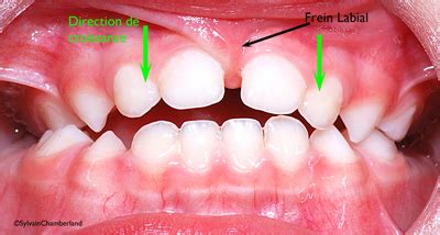 Labial Frenulum Normal