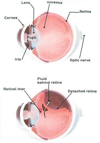 Detached Retina Surgery at best price in Jodhpur by Paliwal Eye Hospital | ID: 19337545862