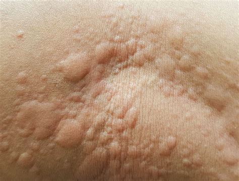 The Best 25 Raised Itchy Bumps On Skin - roadskresz