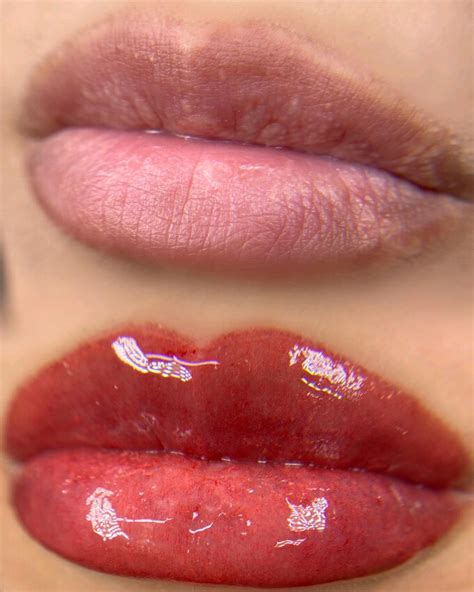 BG Beauty - What are Fordyce spots? Fordyce spots are... | Facebook