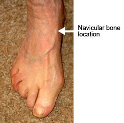 Accessory Navicular Bone | Custom Orthotics | PTI Orthotics Boulder