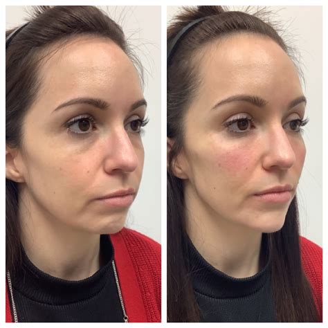 Chin Filler Sanford | Before & Afters - Nectar Aesthetics