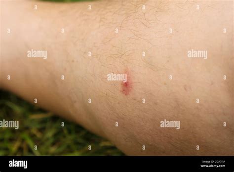 Gnat bite scratched until it bleeds on mans leg, Summer 2021 Stock ...