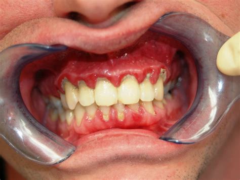 Gingivitis - DocCheck