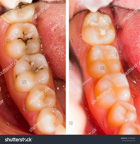 708 Cavity Before After Images, Stock Photos & Vectors | Shutterstock