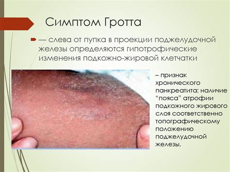 Айзенберга I, II, синдромов селезеночного и печеночного изгибов, слепой ...