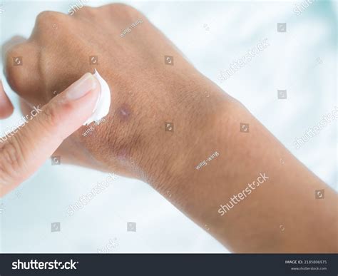 Scar On Hand Woman Finger Applying Stock Photo 2185806975 | Shutterstock