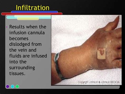 Intravenous Therapy Complications