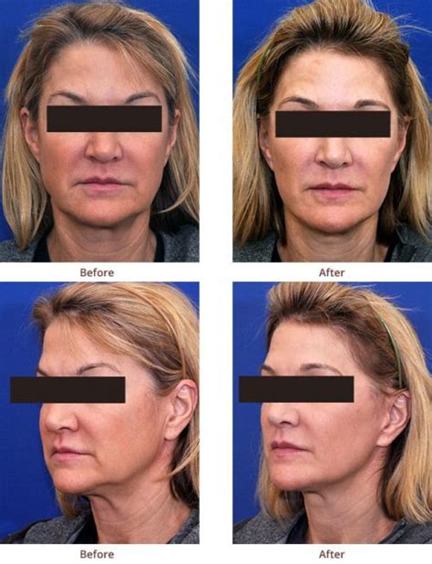 LIFE Before and After Photos | Mini-Facelift