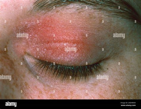 Allergic reaction to eye cosmetic. A red rash on the eyelids of a ...