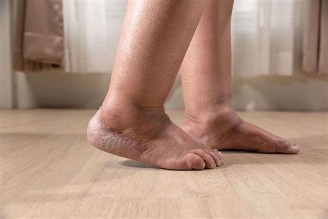 Leg Edema: Causes, Treatment & Its Impact on Wound Care