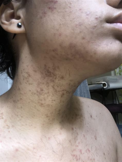 Is it possible to recover from nerve damage after getting MCAS under