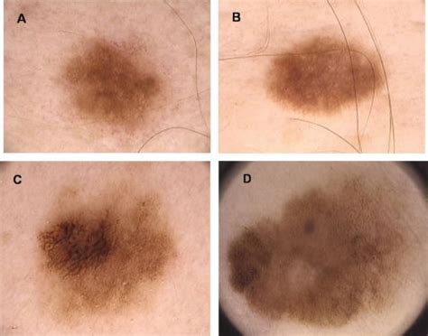 atypical mole syndrome  dysplastic nevi identification