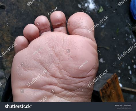 calluses  skin feet cracked foot stock photo  shutterstock