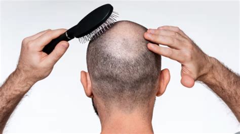 The Most Affordable FUE Hair Transplant Cost