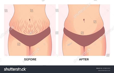 Belly Fat Before After Weight Loss Stock Vector (Royalty Free ...