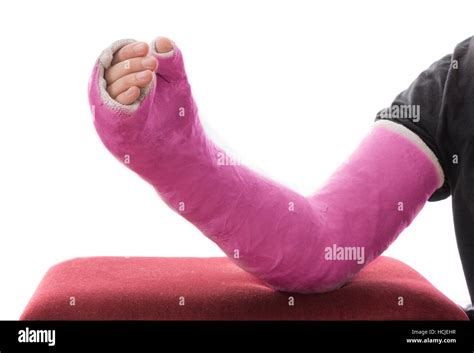 Long arm cast hi-res stock photography and images - Alamy