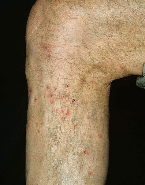 flea bites  humans pictures symptoms  treatment