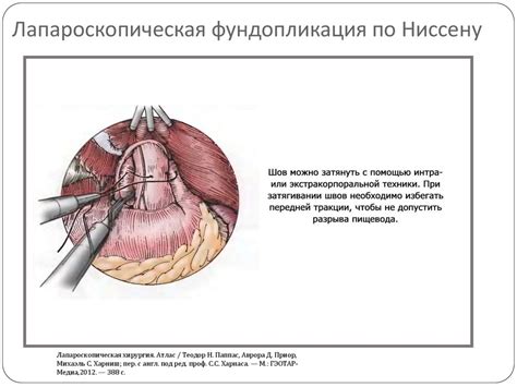 Эндохирургические методы лечения пищевода Барретта - презентация онлайн