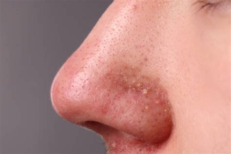 nose pore stock  pictures royalty  images istock