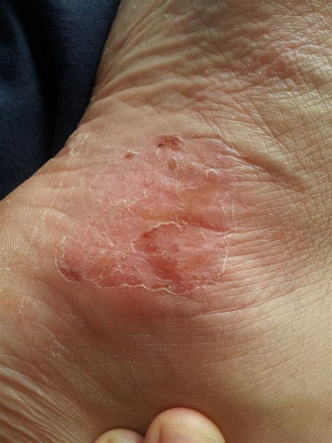 Eczema Bumps Feet at Richard Avitia blog