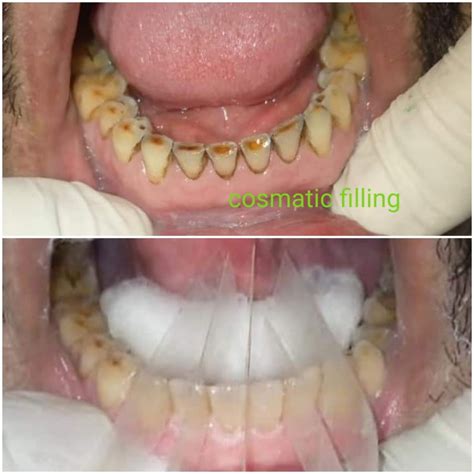 Tooth Surface Loss Management - Odontology Inn