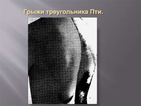 Анатомическое строение треугольника Пти - презентация онлайн