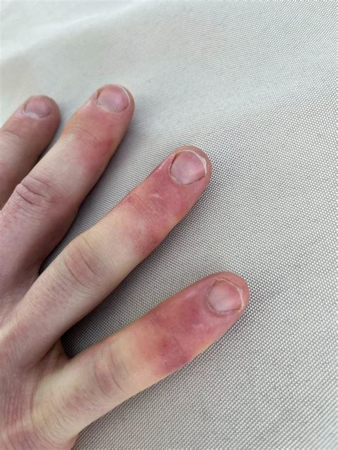 Is this Chilblains on my fingers? : r/DermatologyQuestions