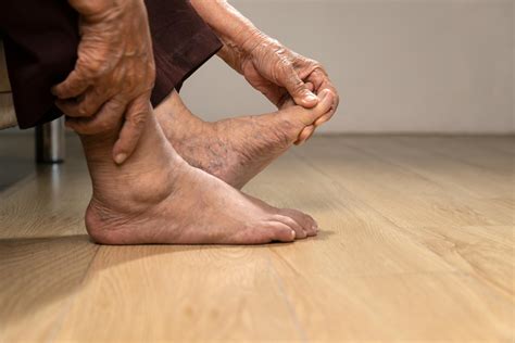 What Is Gout? Symptoms, Causes, and Treatments | CLS Health