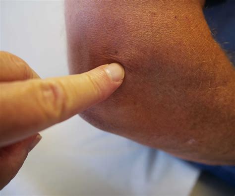 Elbow Archives - Comprehensive Orthopaedics