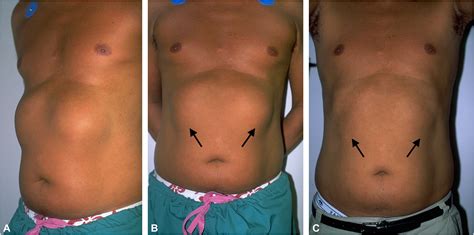 Liposurfomas: Acquired bilateral chest wall fibrolipomas in surfers—7 ...