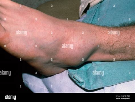 sprained ankle view   swollen left ankle centre due   sprain